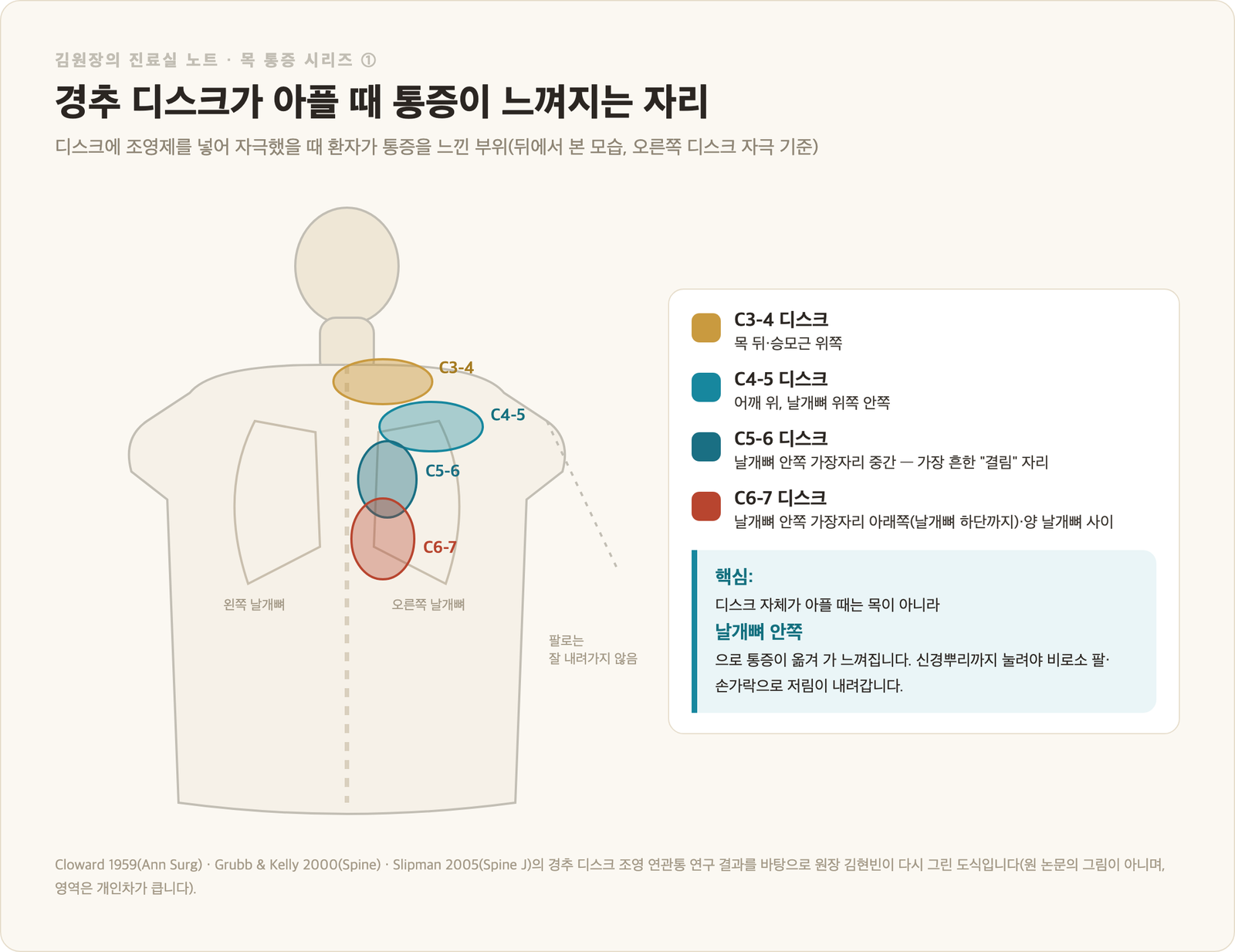 경추 디스크 연관통 지도 - 디스크 조영 자극 시 통증이 느껴지는 부위, C3-4 목 뒤, C4-5 어깨 위, C5-6 날개뼈 안쪽 중간, C6-7 날개뼈 안쪽 아래