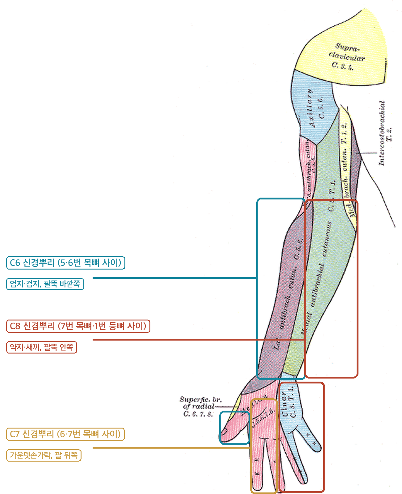 팔 피부감각 분포도 - C6 엄지 검지 팔뚝 바깥쪽, C7 가운뎃손가락, C8 약지 새끼 팔뚝 안쪽 신경뿌리별 저림 부위 표시