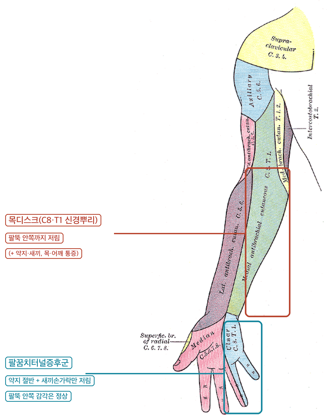 Gray's Anatomy 팔 앞면 피부감각 분포도 - 팔꿈치터널증후군은 새끼손가락과 약지 절반만(청록), 목디스크 C8·T1은 팔뚝 안쪽 피부까지(테라코타) 저림