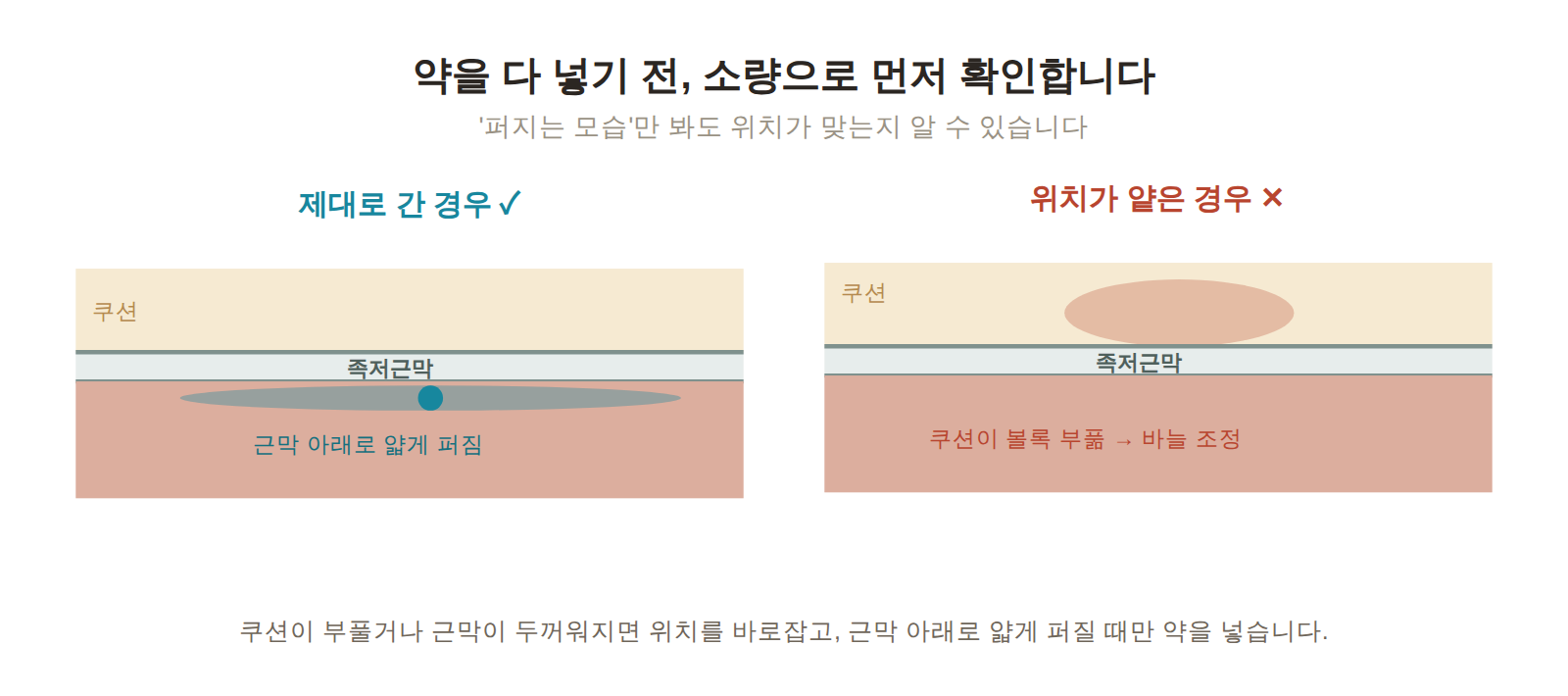 족저근막염 주사 소량 시험 주입 비교 - 약이 근막 아래로 얇게 퍼지면 정상 위치, 지방패드가 볼록 부풀면 바늘이 얕아 조정