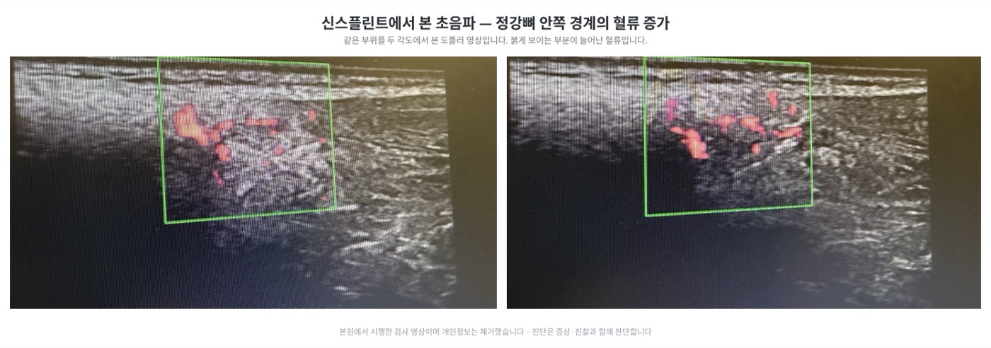 정강뼈 안쪽 경계 부위를 두 각도에서 본 도플러 초음파 영상 두 장. 뼈 표면을 따라 붉은 혈류 신호가 여러 개 보인다