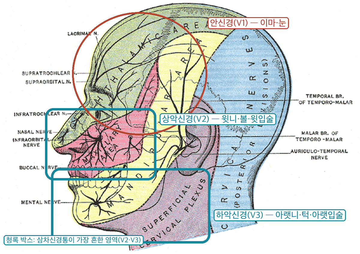 삼차신경 세 분지의 얼굴 감각 영역 지도 - 안신경 V1 이마·눈, 상악신경 V2 윗니·볼·윗입술, 하악신경 V3 아랫니·턱·아랫입술, 삼차신경통이 흔한 V2·V3 영역 청록 박스 표시