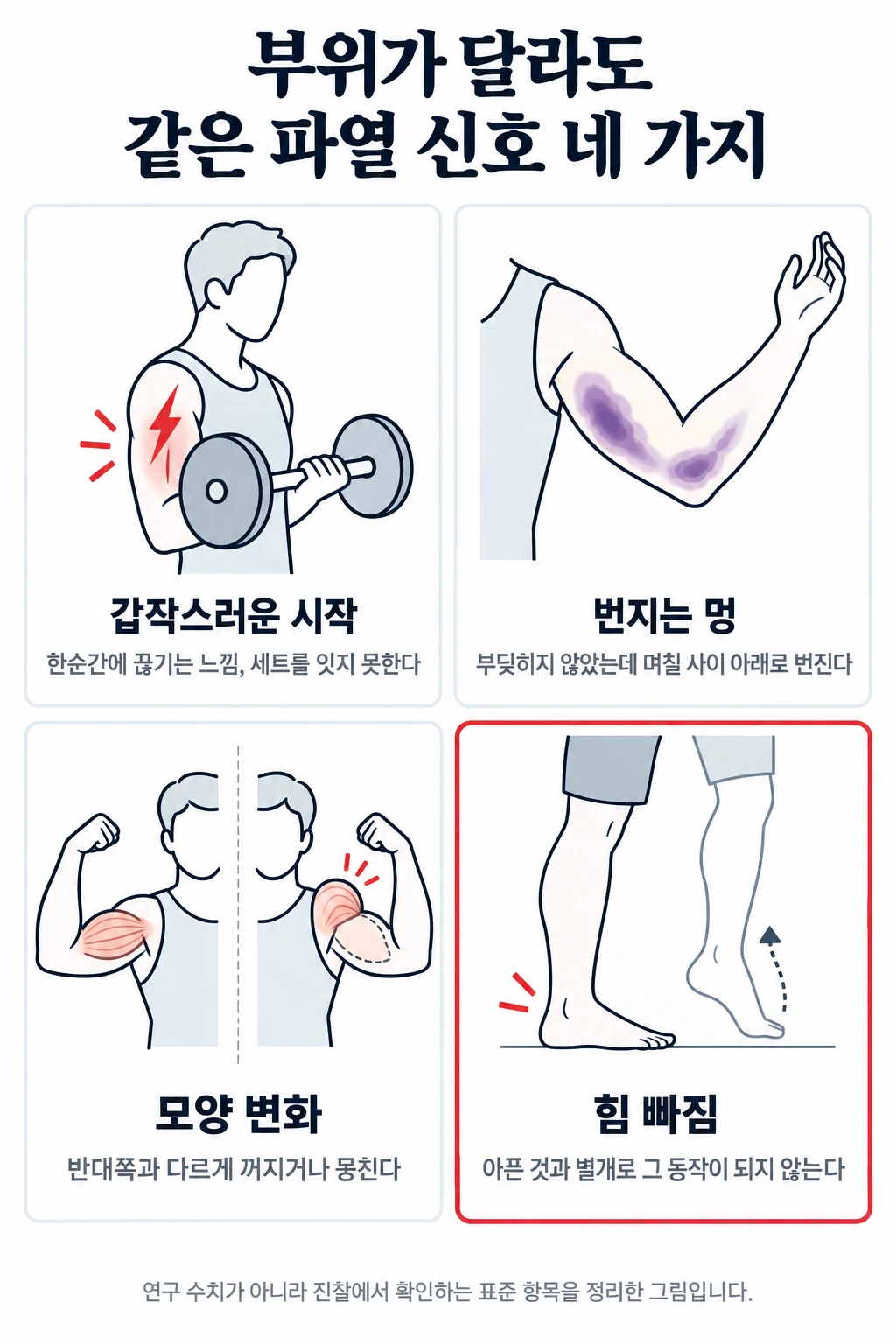 근육·힘줄 파열을 의심하는 네 가지 신호를 네 칸 그림으로 정리했다. 한순간에 끊기는 느낌으로 시작함, 부딪히지 않았는데 며칠 사이 아래쪽으로 번지는 멍, 반대쪽과 다른 근육 모양, 아픈 것과 별개로 특정 동작에 힘이 들어가지 않음